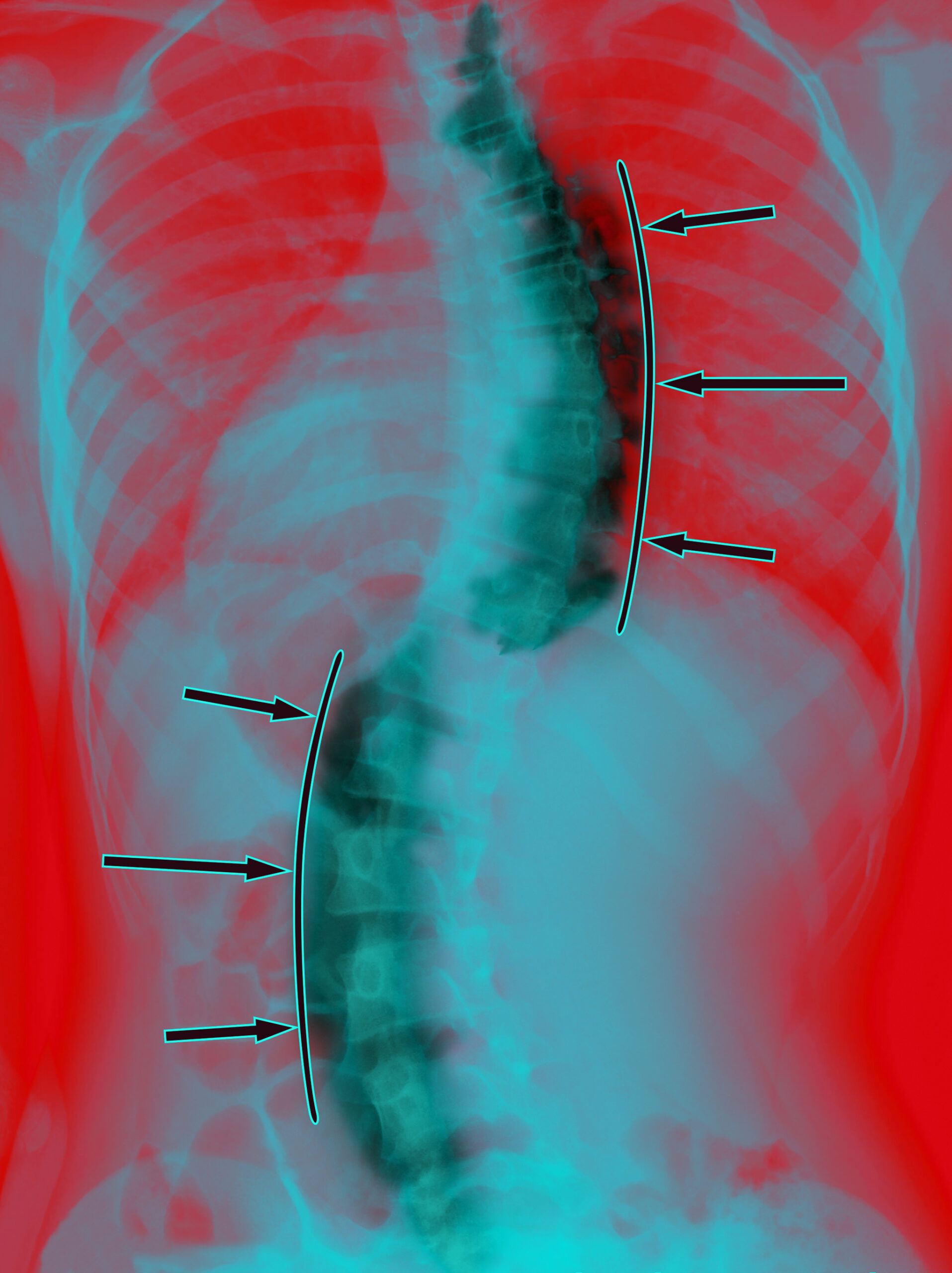 Skoliose Praxis Neurochirurgie Georg Salloum